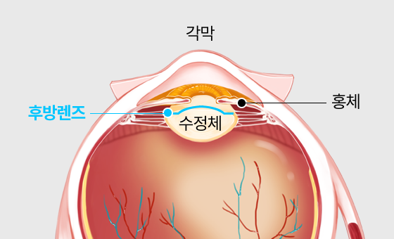 홍채와 수정체 사이에 렌즈를 삽입하는 후방렌즈 위치