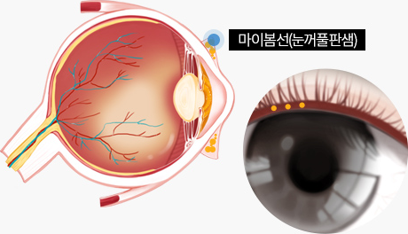 마이봄샘 위치와 안검염 발생 부위를 보여주는 눈 구조