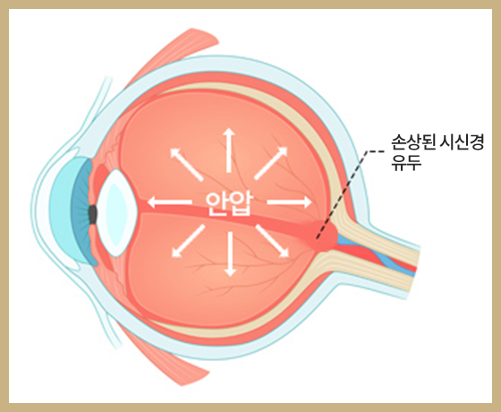 glaucoma