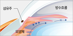 전방각이 폐쇄되어 방수 배출이 차단된 폐쇄각 녹내장 구조
