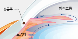 전방각이 열려 있어 방수 흐름이 유지되는 개방각 녹내장 구조