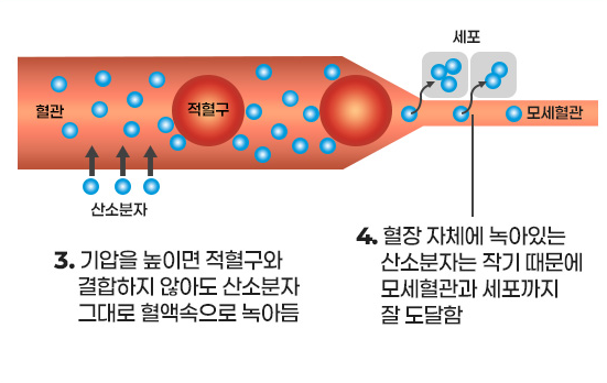 고압산소치료 챔버 내 고기압일 때의 혈관 상태