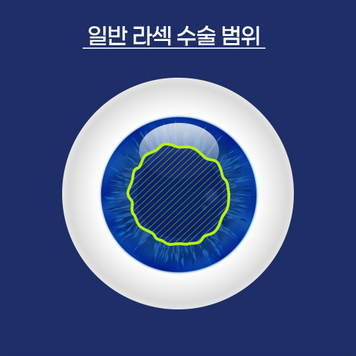 일반 라섹 수술 범위를 표현한 안구 이미지