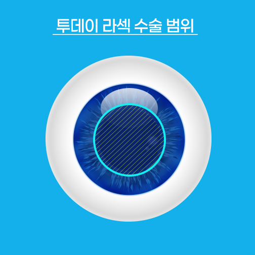 투데이 라섹 수술 범위를 표현한 안구 이미지