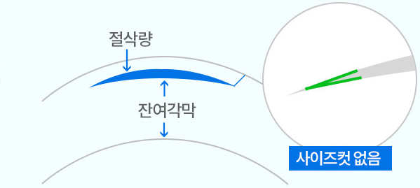 SCHWIND ATOS 뉴 스마일라식의 사이즈컷 없는 절삭 방식