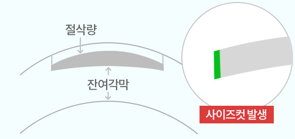 기존 4세대 시력교정술 절삭 방식에서 사이즈컷이 발생하는 모습