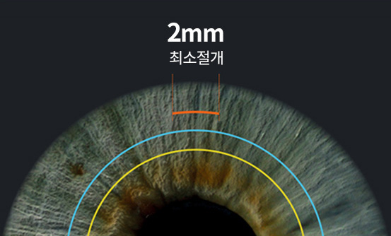 각막 상피를 2mm만 절개하는 최소절개 방식
