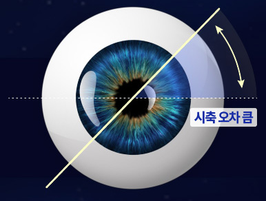 일반 스마일라식 시축 오차 예시