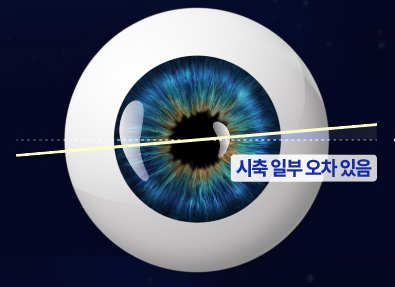 NEW 스마일라식 시축 오차 예시